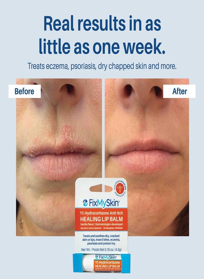 FixMySkin 1% Hydrocortisone Healing Lip Balm, Vanilla – Soothes Dry, Cracked & Irritated Lips, Relieves Chapped Lips, Cold Sores & Eczema, Dermatologist Developed, Travel-Friendly Tube, 0.15 oz - Image 5
